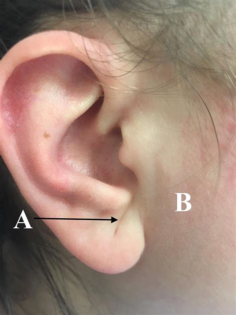 Cureus Franks Sign In Polycystic Ovary Syndrome And Sideburn