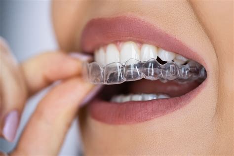 Your Guide To Dental Aligners Discreet Removable Solutions To