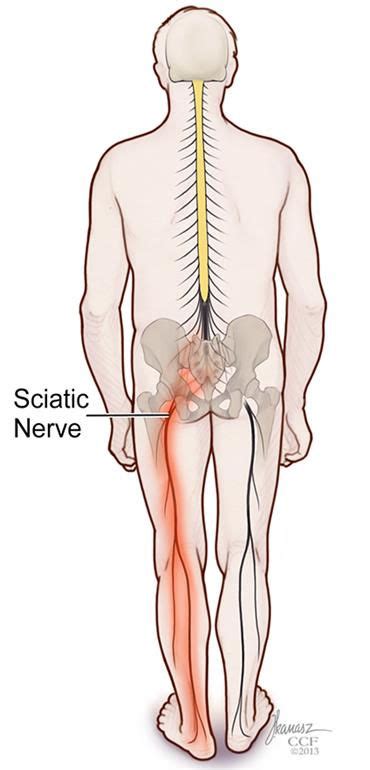 Sciatic Nerve Pain Physical Therapy Can Help