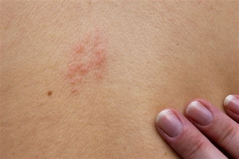 Remedies For Shingles Pain Thriftyfun