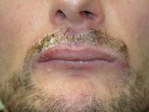Fungal/bacterial lip infection is one of the three primary lip infections. Candida affecting the lips, mouth and face images | DermNet NZ