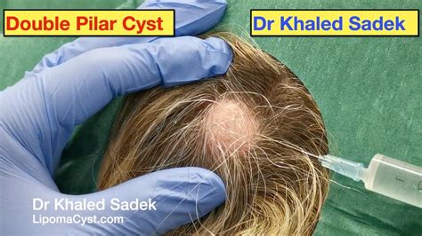 Double Pilar Cyst Removal Part 2 Live Dr Khaled Sadek Youtube