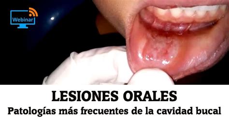 Lesiones Orales Patolog As M S Frecuentes De La Cavidad Bucal Dra