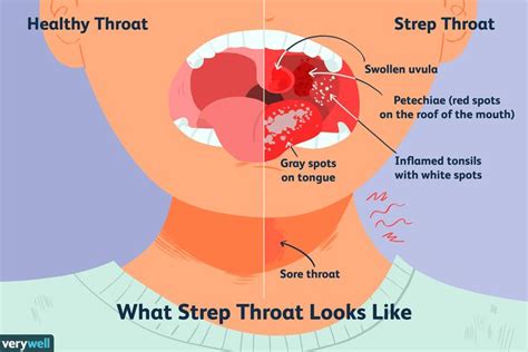 Everything You Need To Know About Strep Throat Strep Throat Swollen Uvula Symptoms Of Strep