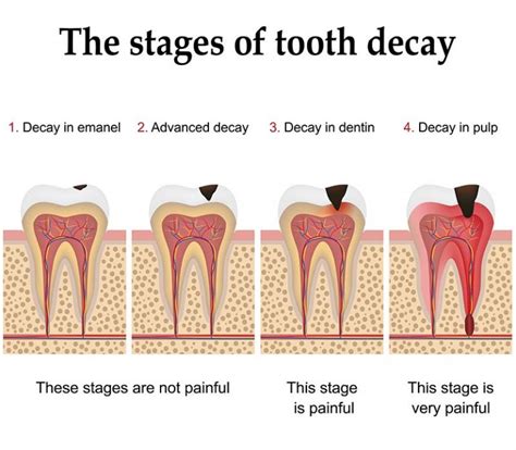 Stages Of Tooth Decay South Gables Dental