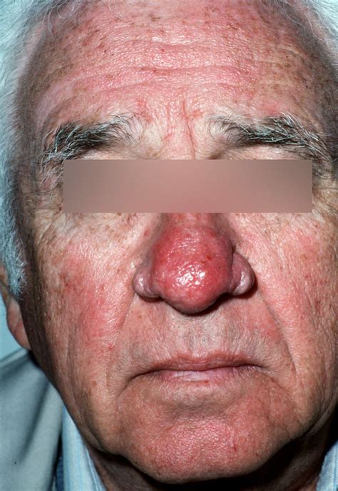 Survey Shows Need For More Awareness Of Rosacea Treatment Options