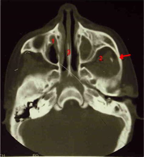 Ocular Cytopathology Anatomy Of The Orbit Ct Scans Images