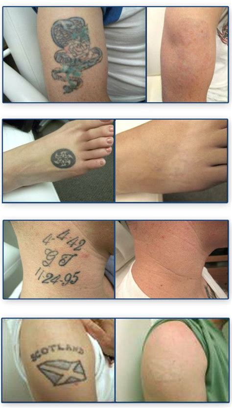 Tattoo Removal Before And After Picosure Tattoo Removal Tattoo
