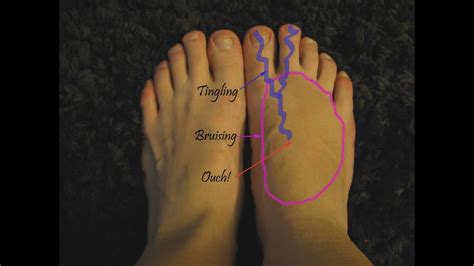 Top Of The Foot Pain Relief Home Treatment Remedies And Causes Youtube