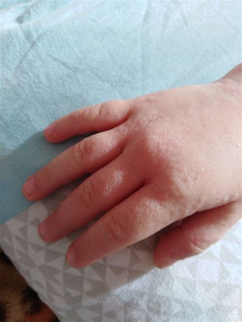 Сыпь у ребёнка на руках Вопрос дерматологу 03 Онлайн