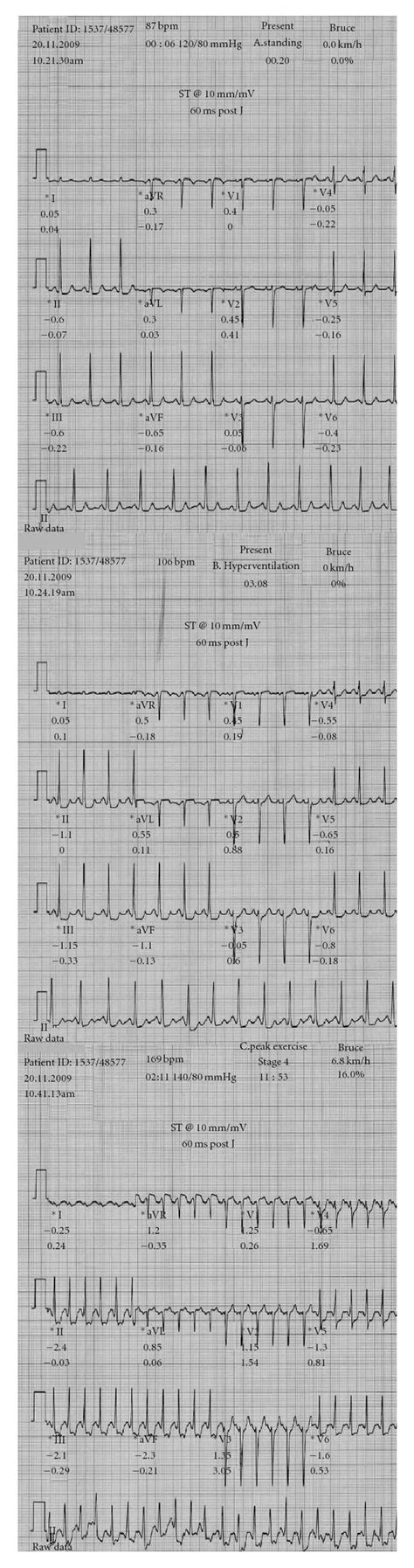 Electrocardiographic Ecg Recordings From A 48 Year Old Woman With Download Scientific Diagram