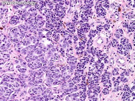 Webpathology.com: A Collection of Surgical Pathology Images