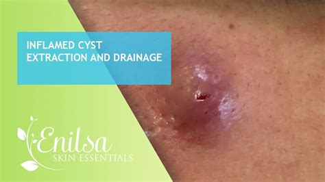 Inflamed Cyst Extraction And Drainage Youtube