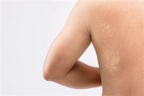 Tinea Versicolor Pityriasis Versicolor A Diary Of Mothering