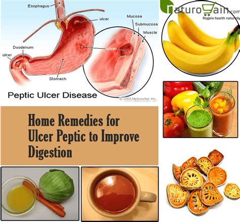8 Best Home Remedies For Ulcer Peptic To Improve Digestion