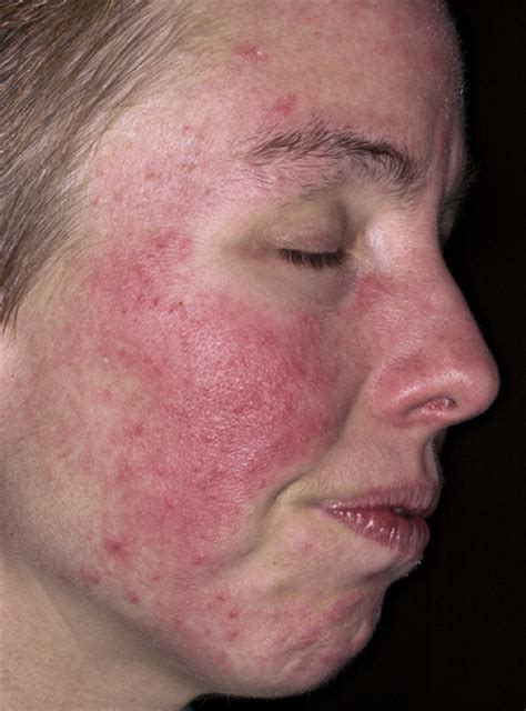 Acne Rosacea Causes Symptoms Treatment Pictures Diet Healthmd