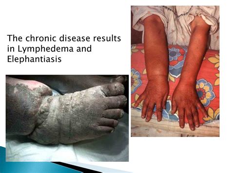 Elephantiasis Disease Causes Symptoms And Elephantiasis