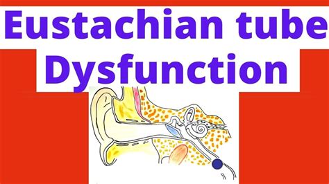 Eustachian Tube Dysfunction Et Dysfunction Causes Symptoms