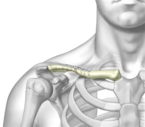 Superior Midshaft Clavicle Plate Upper Extremity Implant Trimed Inc