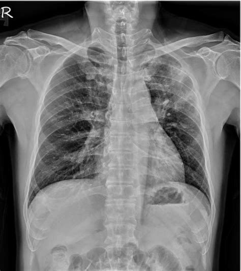 Figure 1 From Endobronchial Lesion In Eosinophilic Granulomatosis With