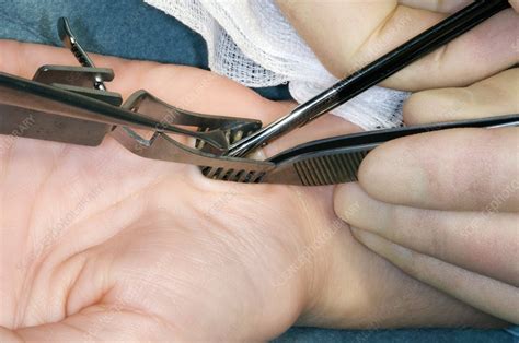 Carpal Tunnel Syndrome Surgery Stock Image C0045135 Science