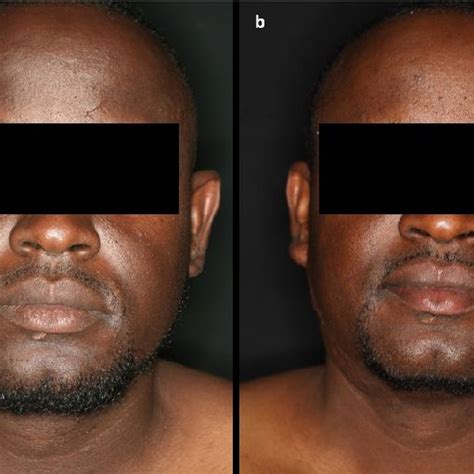 Keloids Of The Neck And Cheek Region Both Sides Before Treatment In A