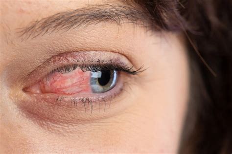 What Is Ocular Rosacea And How To Treat It Skn Clinics