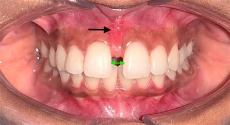 Pretreatment Intraoral Frontal View Revealing A Frenectomy Of The Download Scientific Diagram