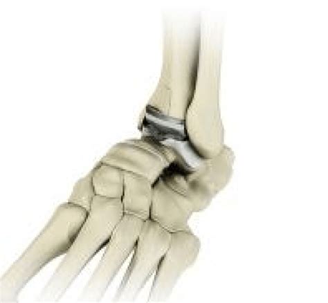 Ankle Joint Replacement Bunbury Foot And Ankle Surgeon