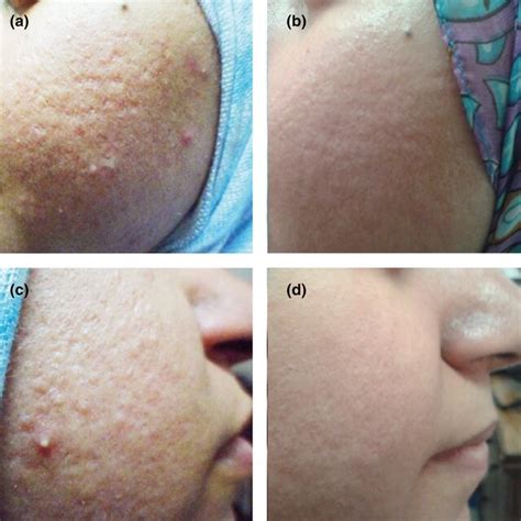 A Atrophic Acne Scars Grade Iii Before Treatment On The Right Side