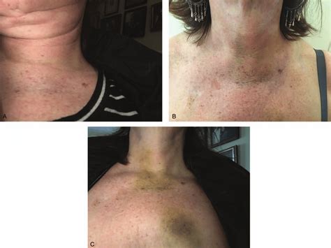 Progression Of Neck Edema And Ecchymosis Days 2 9 A C After Initial