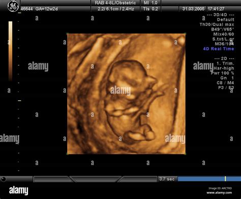12 Week 3d Ultrasound