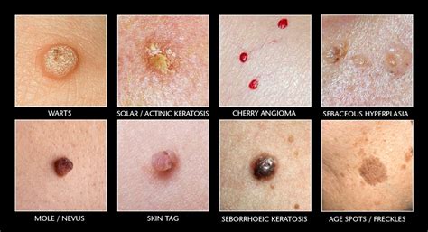 Cryotherapy For Skin Lesions Oving Clinic