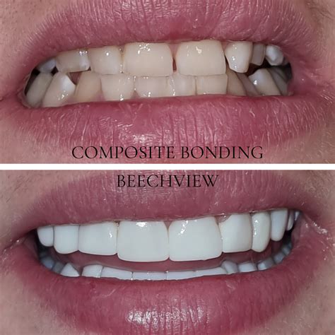 Composite Bonding Dental Bonding Teeth Bonding Beechview Dental