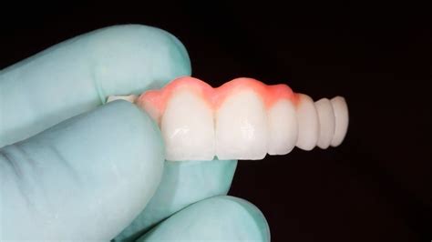 Puente Dental Qu Es Y Diferencias Con Un Implante