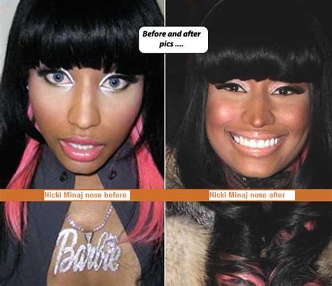 nicki minaj plastic surgery before and after pictures 2016