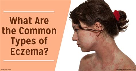 What Are The Common Types Of Eczema