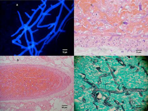 Microbiological And Histopathological Examination Of The Resected Download Scientific Diagram
