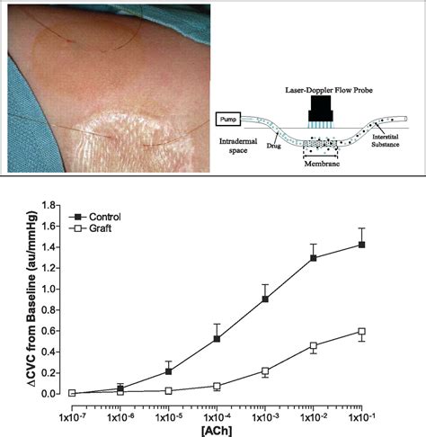 Cutaneous Vascular And Sudomotor Responses In Human Skin Grafts Journal Of Applied Physiology