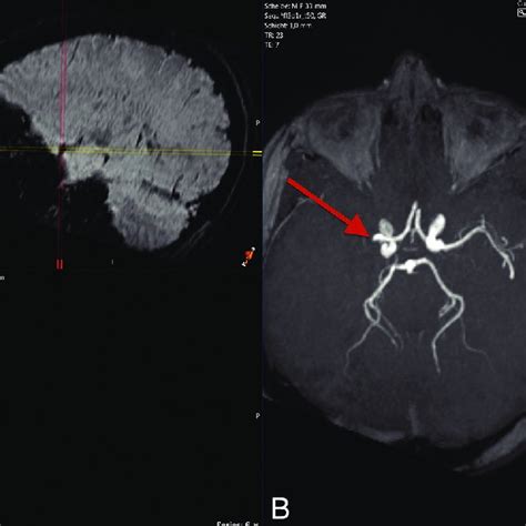 A Patient With Acute Ischemic Stroke After Occlusion Of The Basilar
