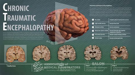 Chronic Traumatic Encephalopathy, a killer disease | SiOWfa16: Science ...