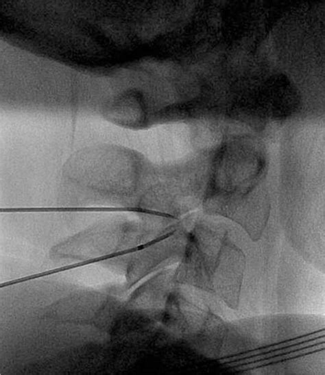 A Lateral Radiograph Demonstrating The Second Left And Third Right