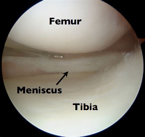 Torn Meniscus Recovery Time Jeffrey H Berg Md