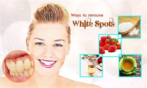 34 Best Ways To Remove White Spots From Teeth Fast And Naturally