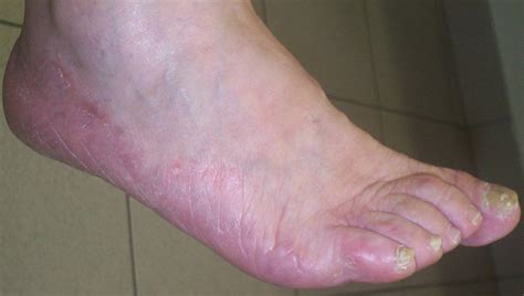 Type 2 Diabetes Swollen Feet And Ankles Walking