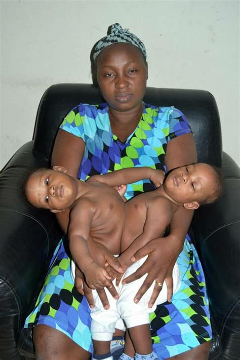 22 Indian Doctors Successfully Separate Nigerian Conjoined Twins