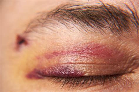 Close View Of A Bruise Near The Eye The Face Of A Man With A Hematoma Stock Photo Image Of