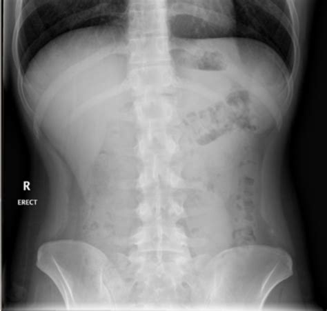 Radiology Exam 1 Abdominal Xray Interpretation Flashcards Quizlet