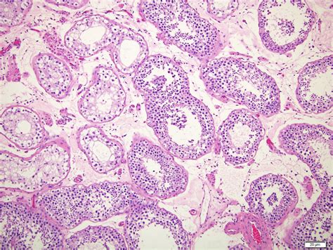 Pathology Outlines Germ Cell Neoplasia In Situ Hot Sex Picture