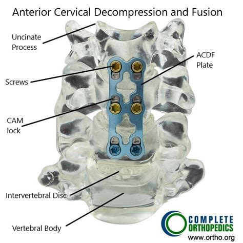 Cervical Spine Fusion Minimally Invasive Complete Orthopedics